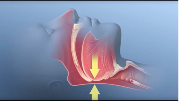 Central vs. Obstructive Sleep Apnea: What Are The Main Differences ...